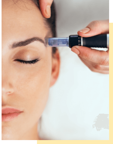 microneedling