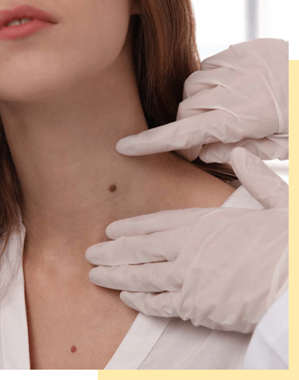 skin-tag