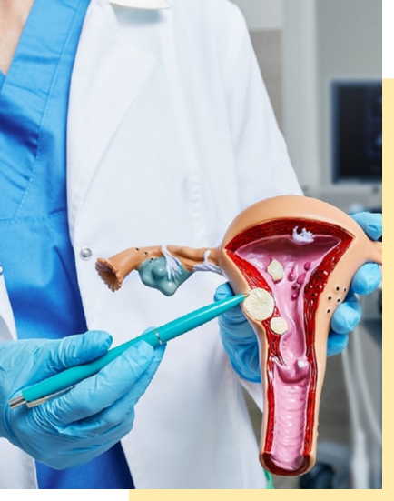 fibroids