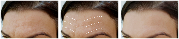 botox