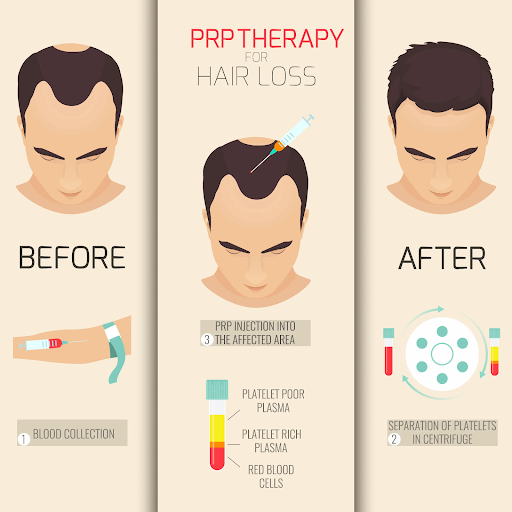 PRP therapy for hair treatment is ideal to get back shinny hairs with PRP therapy expert