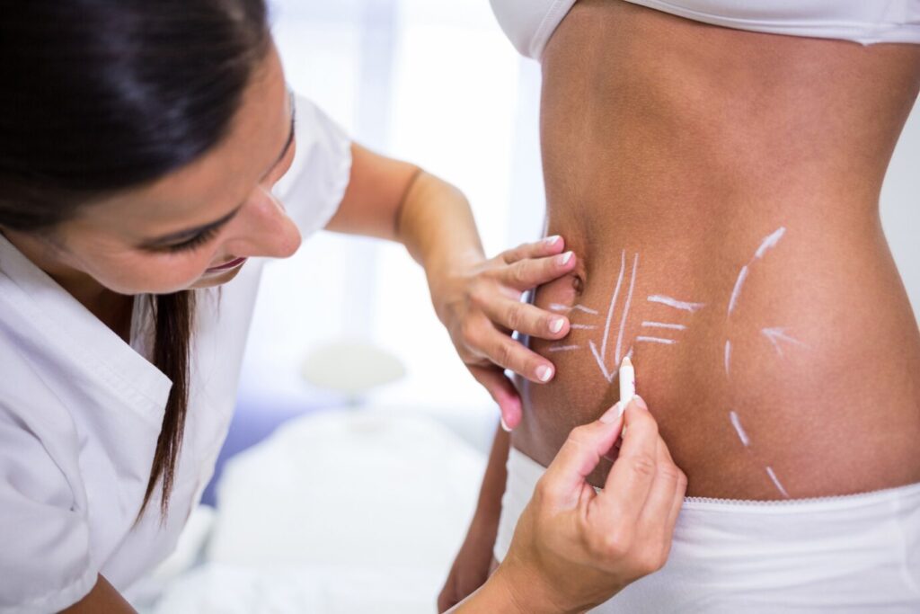 A specialist drawing contouring marks on a woman's abdomen for a body sculpting treatment.