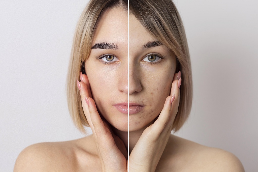 Skin Rejuvenation
